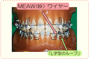 MEAW（妙）ワイヤー